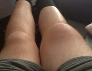 Swollen Knee